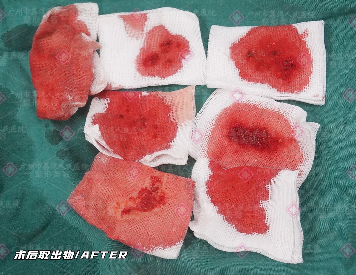 为什么注射水分子丰体针后不会被吸收代谢