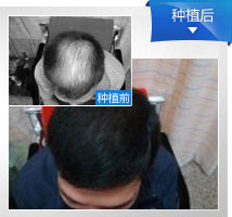 头发种植效果图