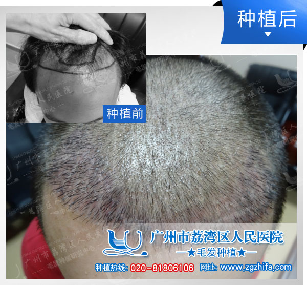 植发效果图