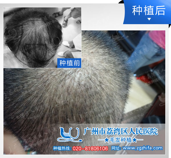 植发效果图