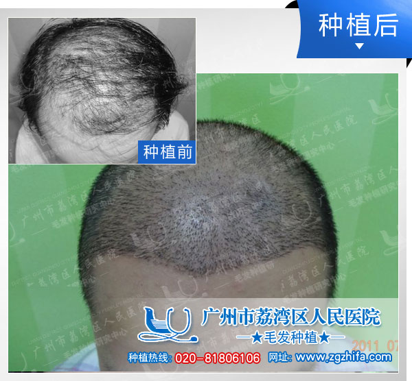 植发效果图