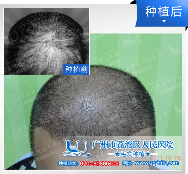 植发效果图