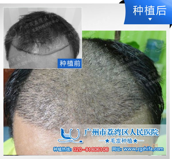 植发效果图