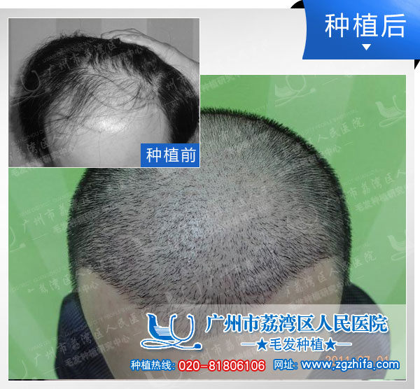 植发效果图