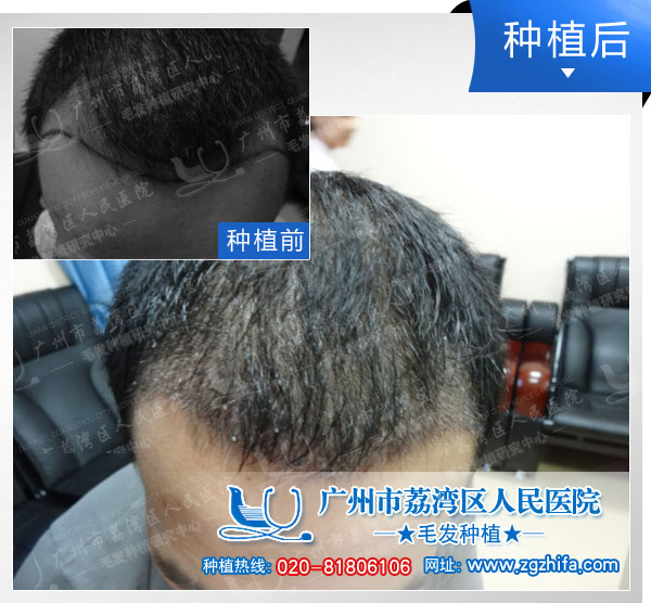 植发效果图