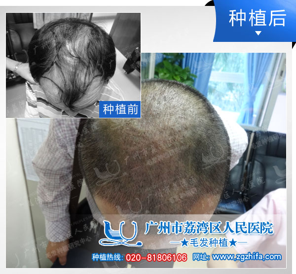 植发效果图