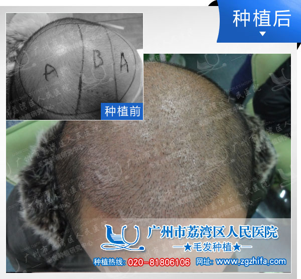 植发效果图
