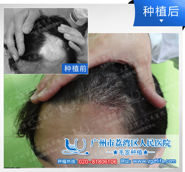 植发效果图