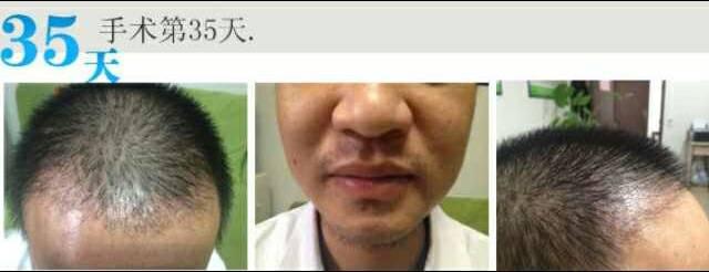 植发手术过程图片5