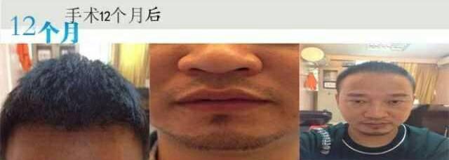 植发手术过程图片7
