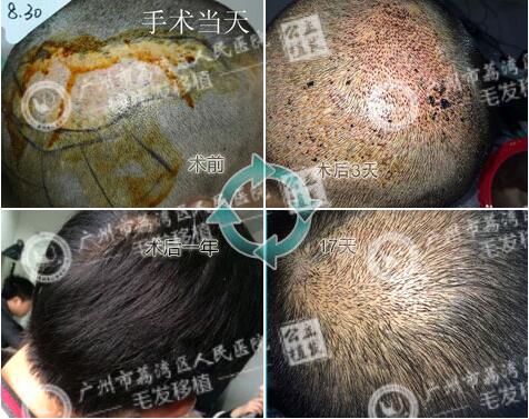 头发种植
