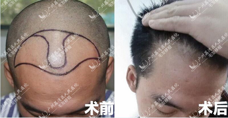 头发种植
