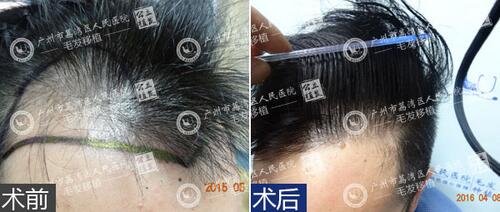 头发种植